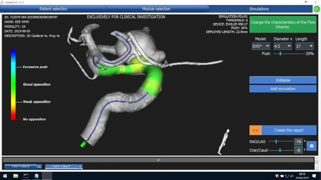 Treating a right ICA aneurysm using an EVOLVE flow diverter