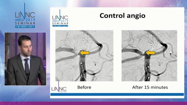 Endovascular bail-out after massive rupture for elective basilar tip aneurysm coiling