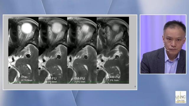 No cure of a MCA aneurysm with small side-branch at the neck after FD treatment