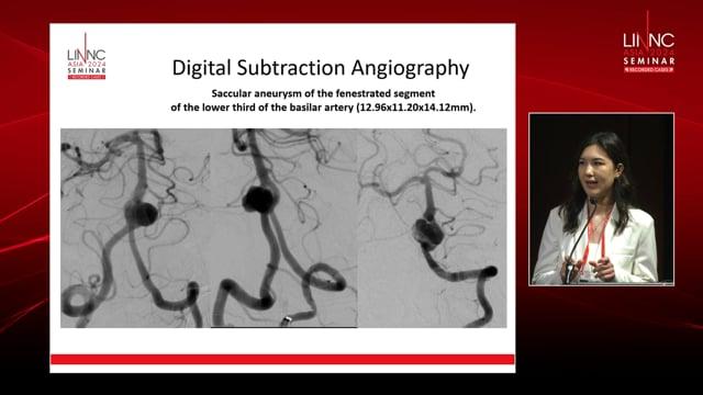 ‘Kissing’ flow diverters in case of fenestrated basilar artery aneurysm