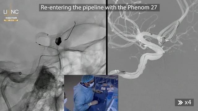 Recurrent previously clipped aneurysm ACOM aneurysm treated by bilateral flow-diverter reconstruction of ACAs; a first malpositionned FD is removed with a lasso