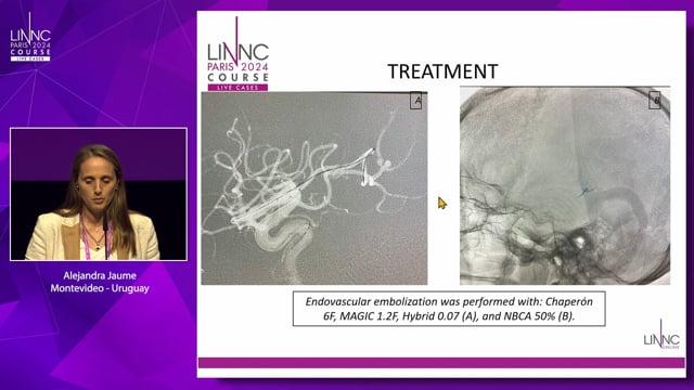 Intracranialmycotic aneurysm