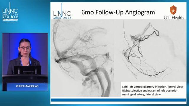 From Ruptured PICA Aneurysm to Tentorial dAVF: Evolution of a Secondary Vascular Lesion