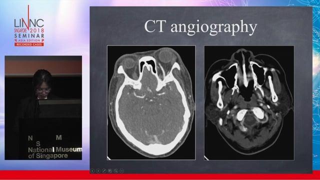 Transvenous embolization of carotid-cavernous fistula via Pterygoid plexus access  