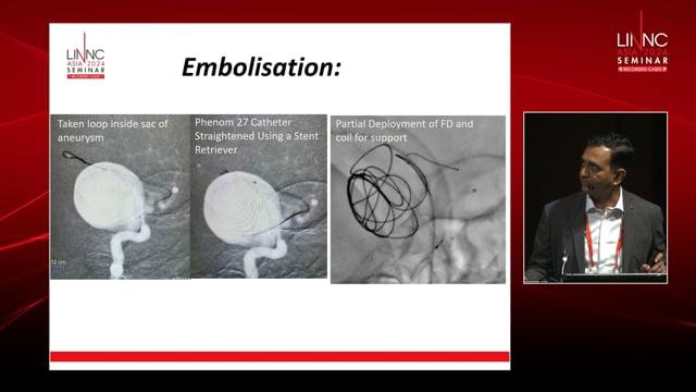 Delayed Thrombotic Occlusion of a Recoiled Flow Diverter Managed with a Coronary Stent (Double stenting)