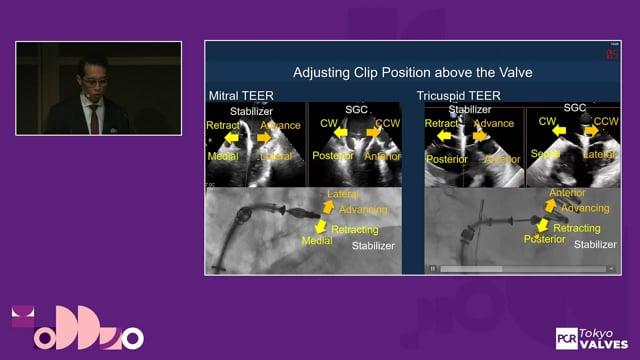 Getting ready for tricuspid