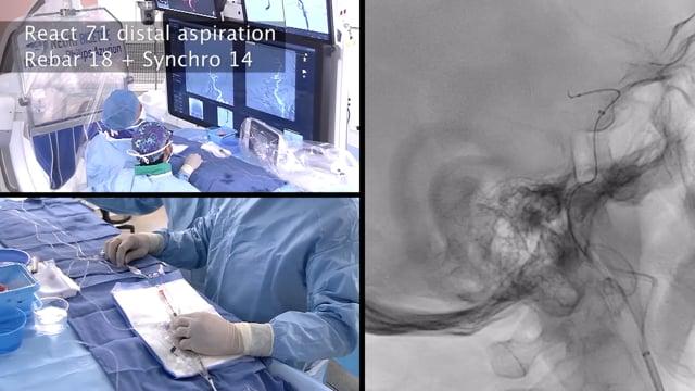 Recanalization of a left MCA occlusion in a centenarian patient with the BADASS technique