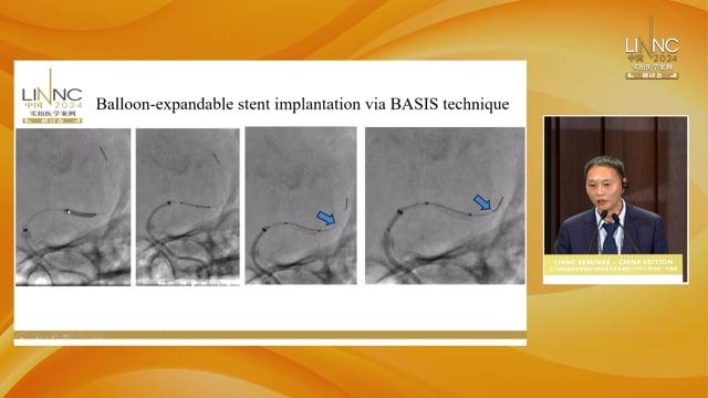 The Application of BASIS Technique Combined with OCT in Chronic Internal Carotid Artery Occlusion
