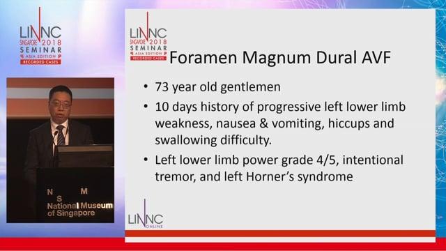 Foramen magnum dural AV fistula treated by transarterial embolisation 