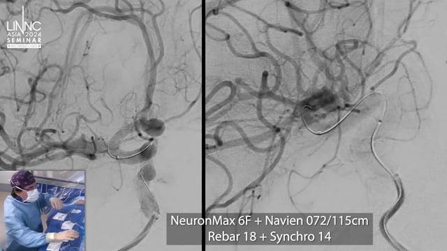 Incidental anterior communicating aneurysm treated with Artisse intrasaccular device