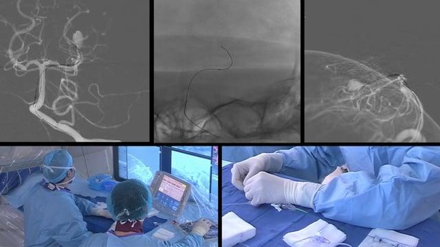 Ruptured dissecting left P2 aneurysm