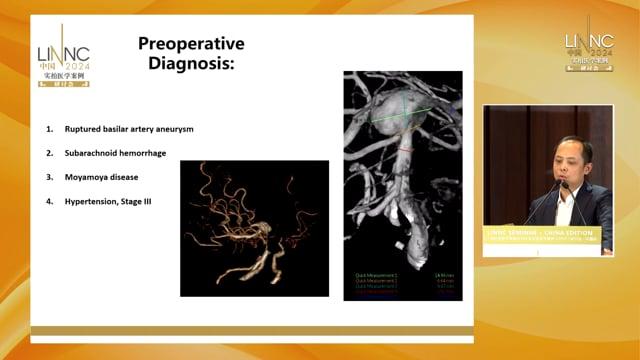 Neurointerventional treatment of Moyamoya disease with  basal artery complex aneurysm