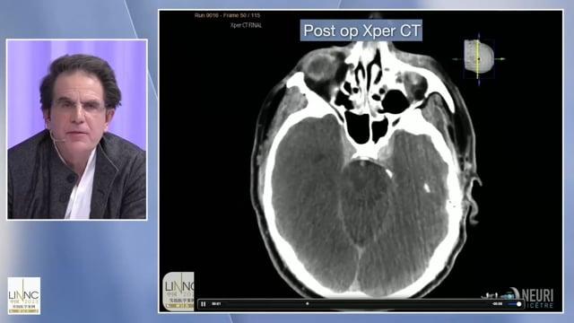 Lasercut and braided stents: Enemy brothers?