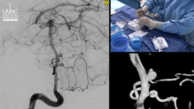 Concurrent treatment of ruptured dysplastic wide-neck basilar tip aneurysm and dysplastic AICA aneurysm with coiling and balloon remodeling