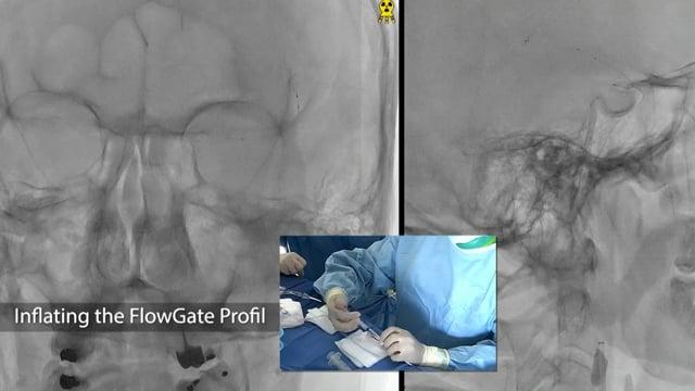 Low NIHSS thrombectomy: benefit risk balance of GA