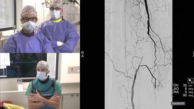 SFA and popliteal interventions