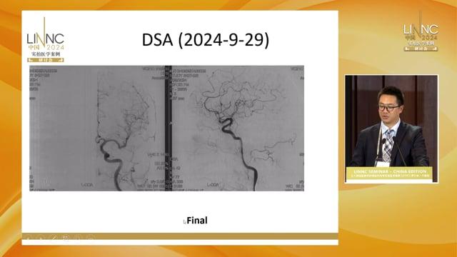 Lateral sinus dural arteriovenous fistula embolisation with venous remodelling following venous sinus stenting