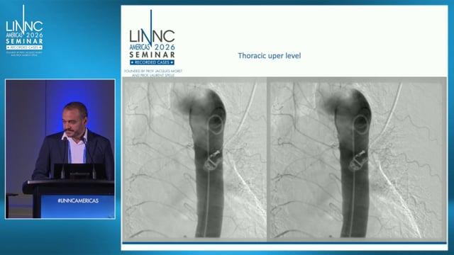 A Fistula hard to find