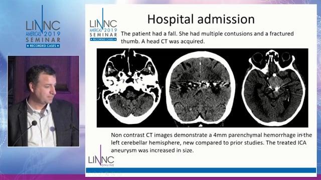 Mechanical thrombectomy in a patient with previously treated giant fusiform aneurysm
