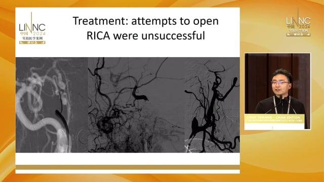 A Case Report on the Recurrence of a PComA Aneurysm after Y stent assisted embolization