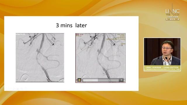 Endovascular treatment for acute left intracranial vertebral artery occlusion with underlying ICAD - a case of progressive stroke