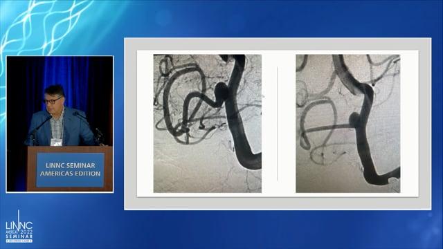 Stryker Industry Sponsored Symposium: 64 Wire Surpass Evolve; Early case & clinical experience