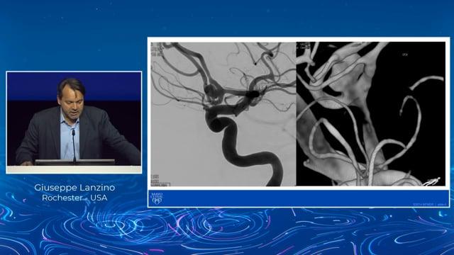 Progressive parent artery thrombosis after WEB
