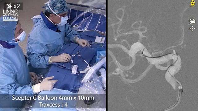 Right MCA bifurcation aneurysm treated with balloon-assisted intrasaccular flow disruptor