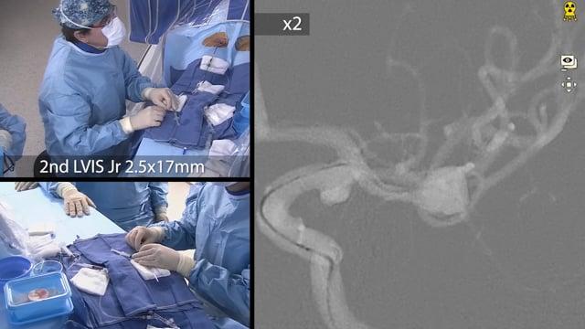 Dissecting vertebral artery aneurysm treated with a flow diverter