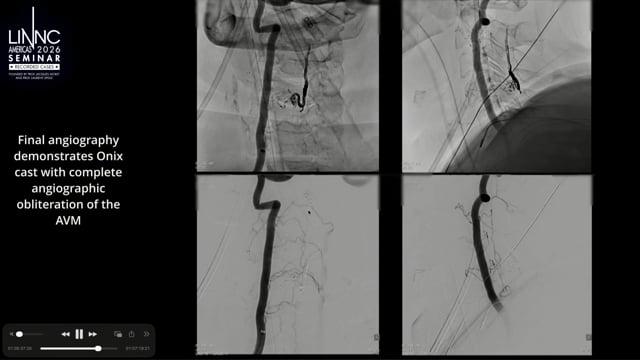 The treatment of a complicated Perimedullary AVM on the spinal cord