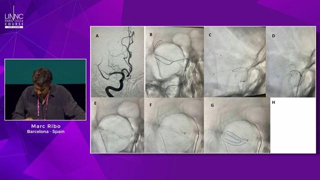 Double the bet: large bore, twin stent or all in?