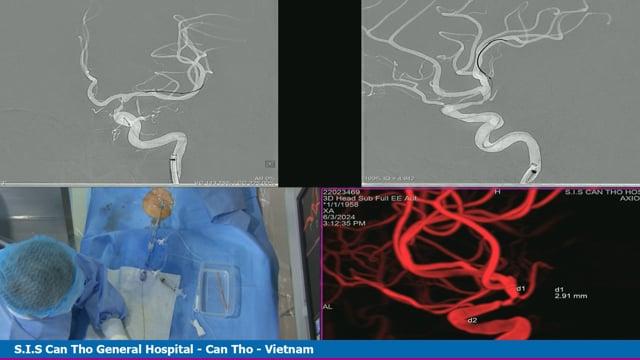 Intracranial atherosclerotic disease - Live Case 