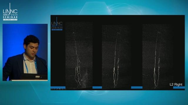 Fistula Dural Medular case: An artery or a vein?