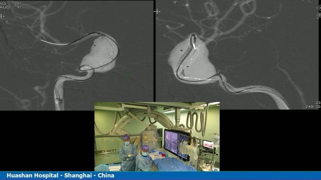 FD assisted coiling for right giant ICA Aneurysm