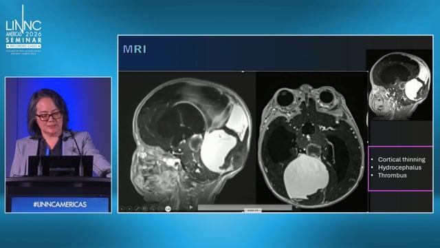 From pial arteriovenous fistula (PAVF) to nidal AVM, same treatment?