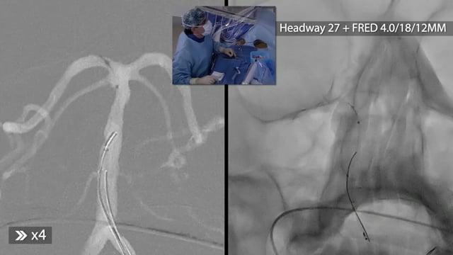 Treatment of a blood-blister-like aneurysm of the BA with coil and FD