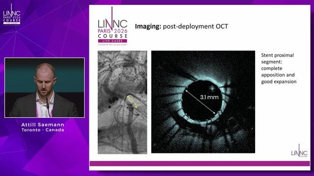 OCT-guided stenting of symptomatic left vertebro-basilar junction stenosis