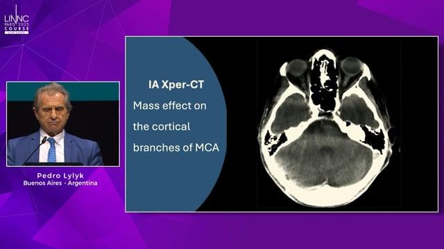 Transvascular access to the subdural space: embolization and endovascular evacuation of subdural hematomas (EMBODRAIN study)