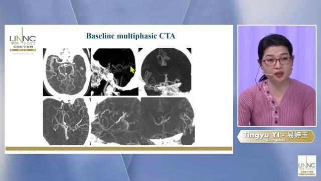 Dilemna: ICAS with distal high-volume thrombus Solution: BASIS technique