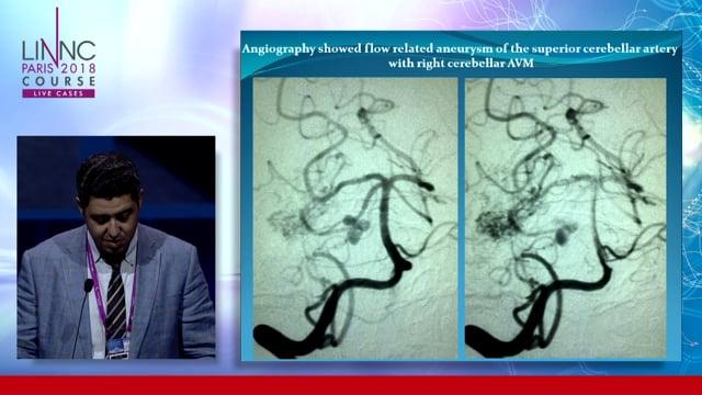 AVM with flow related aneurysm 
