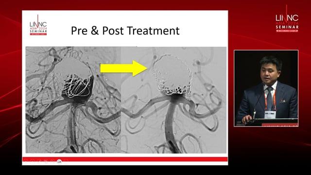 Recurrent Giant Basilar Artery Aneurysm