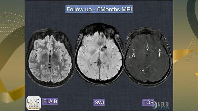 Trans arterial embolization of a caudate AVM
