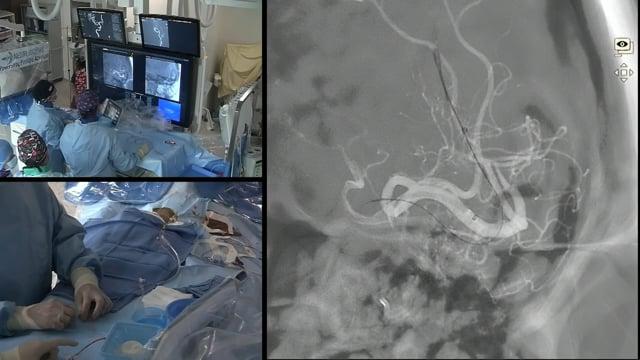 Delayed and distal occlusion thrombectomy still benefits to the patient