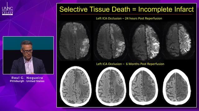 Thrombectomy Without Borders: The Next Leap in Global Stroke Treatment