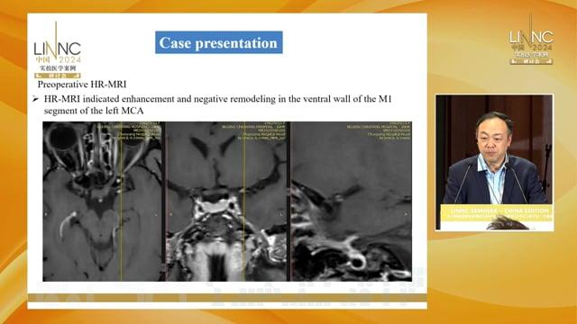 Moyamoya Disease Aneurysm Treatment