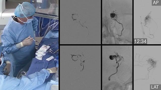 Stent coil for a giant LICA aneurysm