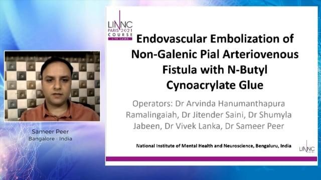 Endovascular Embolization of Non-Galenic Pial Arteriovenous Fistula with N-Butyl Cynoacrylate Glue