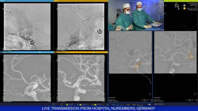 Left MCA fusiform aneurysm treated by FD and coils