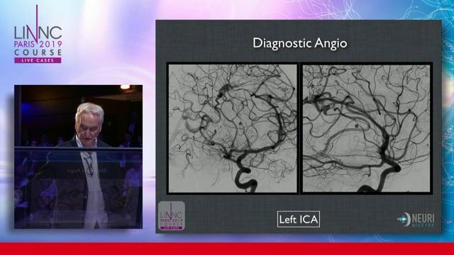 A complex treatment: a venous approach to embolization of a deep AVM