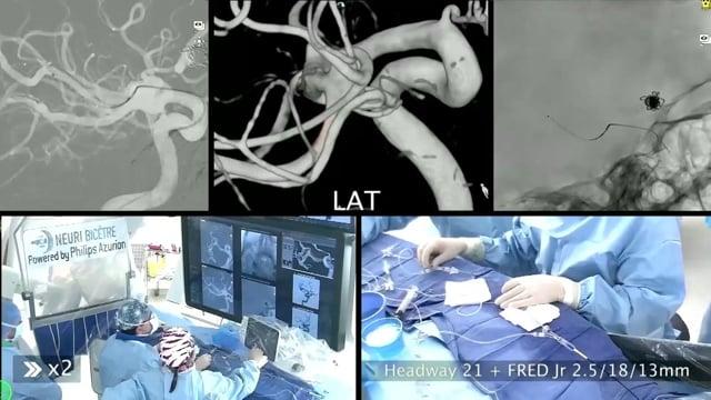 FD and WEB for bifurcation aneurysm: a complementary competition?